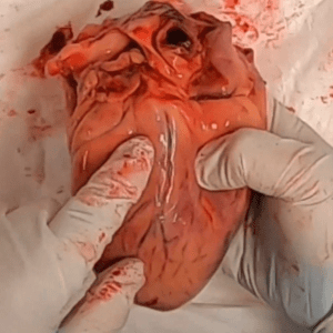 Heart - external, coronary artery